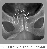 シードを埋め込んだ状態のレントゲン写真