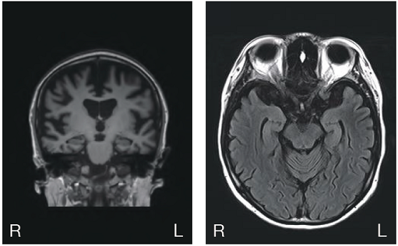 頭部MRI1