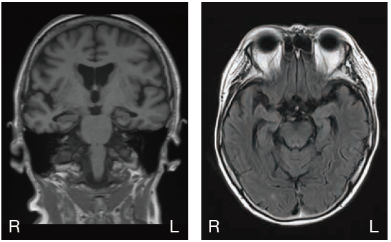 頭部MRI1