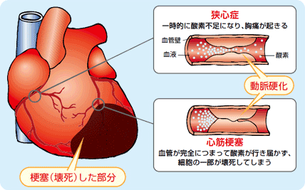 知っていますか 透析を始めたら 心臓ケア が大切なこと 日本メジフィジックス株式会社