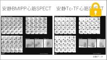 症例4～まとめ　50代男性(主訴：不整脈感)　サムネイル